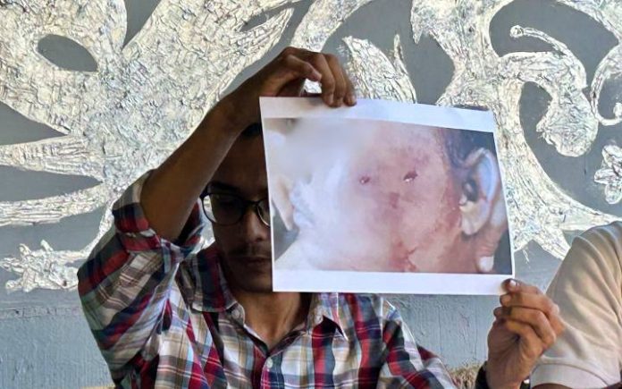 Kaops LBH Banda Aceh Sulaimansyah Dianiaya Oknum TNI Hingga Tewas, Keluarga Minta Keadilan Kaops LBH Banda Aceh Muhammad Qodrat memperlihatkan bekas luka dan lebam di muka Sulaimansyah. Foto: Komparatif.ID/Fuad Saputra.