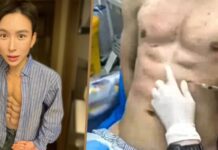 Terobsesi Perut Six-Pack Instan, Influencer China Ini Bayar Rp9 M Untuk Suntik Hialuronat Terobsesi Perut Six-Pack Instan, Influencer China Ini Bayar Rp9 M Untuk Suntik Hialuronat