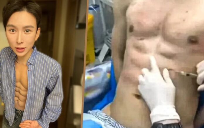 six pack Terobsesi Perut Six-Pack Instan, Influencer China Ini Bayar Rp9 M Untuk Suntik Hialuronat