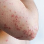 93,5 Persen Kasus Campak di Aceh Terjadi pada Anak Tanpa Imunisasi 93,5 Persen Kasus Campak di Aceh Terjadi pada Anak Tanpa Imunisasi