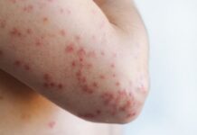 93,5 Persen Kasus Campak di Aceh Terjadi pada Anak Tanpa Imunisasi 93,5 Persen Kasus Campak di Aceh Terjadi pada Anak Tanpa Imunisasi