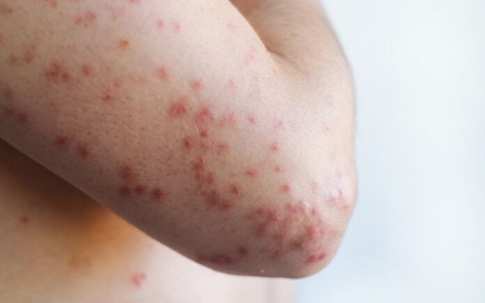 93,5 Persen Kasus Campak di Aceh Terjadi pada Anak Tanpa Imunisasi