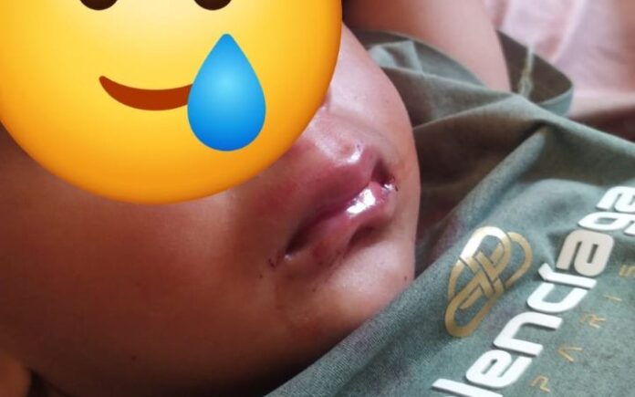 fahreza Terdata Desil 8, Balita Keluarga Miskin Korban Kecelakaan Pilih Berobat ke Polindes
