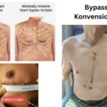 Mengenal Prosedur Operasi MICS-CABG Mengenal Prosedur Operasi MICS-CABG