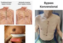 Mengenal Prosedur Operasi MICS-CABG Mengenal Prosedur Operasi MICS-CABG