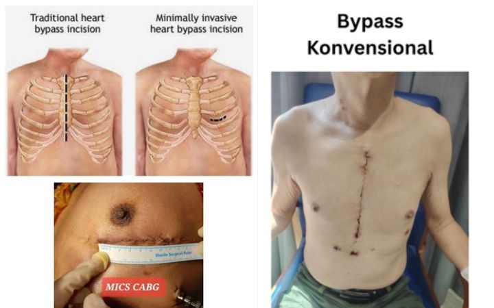 Mengenal Prosedur Operasi MICS-CABG